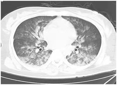 Negative pressure pulmonary edema: a case report and literature review